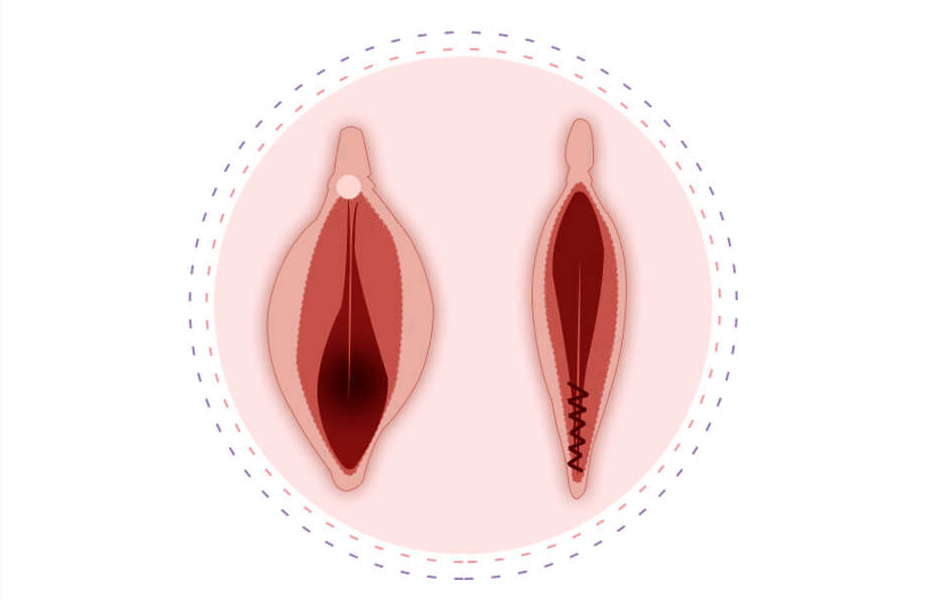 علل و درمان شلی واژن