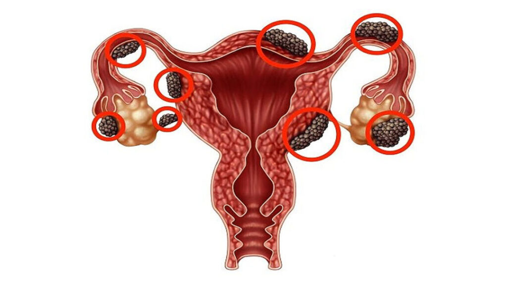 کیست های شکلاتی یا اندومتریوز