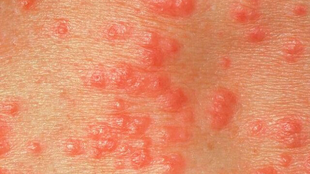 علائم تبخال تناسلی و روش های درمان آن